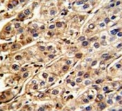 IHC analysis of FFPE human hepatocarcinoma stained with SHP2 antibody