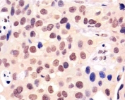 IHC testing of FFPE human breast carcinoma with BANP antibody at 1:25. HIER: steamed in pH6 citrate buffer.