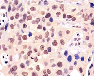 IHC testing of FFPE human breast carcinoma with BANP antibody at 1:25. HIER: steamed in pH6 cit