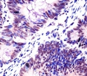 IHC testing of FFPE human colorectal carcinoma with SAM68 antibody at 1:25. HIER: steamed in pH6 citrate buffer.