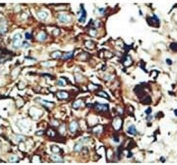IHC testing of FFPE human breast cancer with PACSIN2 antibody at 1:50. HIER: steamed with pH6 citrate buffer.