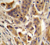 IHC testing of FFPE human bladder carcinoma with RBCK1 antibody. HIER: steam section in pH6 citrate buffer for 20 min.