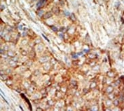 IHC testing of FFPE human breast carcinoma tissue with GCK antibody.
