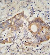 IHC staining of FFPE human colon cancer with HHLA2 antibody. HIER: boil tissue sections in pH6, 10mM citrate buffer, for 20 min and allow to cool before testing.