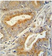 IHC testing of FFPE human prostate carcinoma with BCORL1 antibody. HIER: steam section in pH6 citrate buffer for 20 min and allow to cool prior to staining.