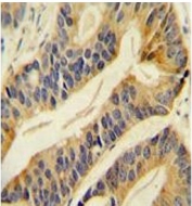 IHC testing of FFPE human prostate carcinoma with SLC16A11 antibody. HIER: steam section in pH6 citrate buffer for 20 min and allow to cool prior to staining.