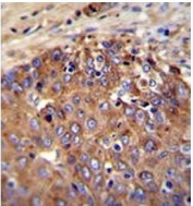 IHC testing of FFPE human hepatocarcinoma with NOS2 antibody. HIER: steam section in pH6 citrate buffer for 20 min and allow to cool prior to staining.