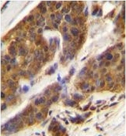 IHC testing of FFPE human bladder carcinoma with Complement Factor D antibody. HIER: steam section in pH6 citrate buffer for 20 min and allow to cool prior to staining.