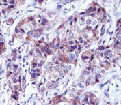 IHC testing of FFPE human breast carcinoma tissue with Alpha Lactalbumin antibody. HIER: steam section in pH6 citrate buffer for 20 min and allow to cool prior to staining.