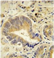 IHC testing of FFPE human colon carcinoma with IDUA antibody. HIER: steam section in pH6 citrate buffer for 20 min and allow to cool prior to staining.