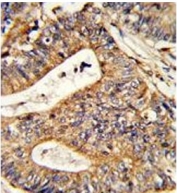 IHC testing of FFPE human colon carcinoma with CALR antibody. HIER: steam section in pH6 citrate buffer for 20 min and allow to cool prior to staining.