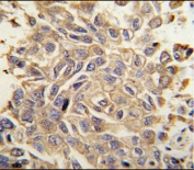 IHC testing of FFPE human lung carcinoma with RYK antibody. HIER: steam section in pH6 citrate buffer for 20 min and allow to cool prior to staining.
