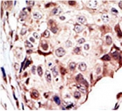 IHC testing of FFPE human breast cancer with RYK antibody. HIER: steam section in pH6 citrate buffer for 20 min and allow to cool prior to staining.