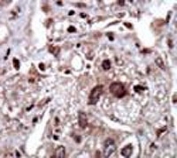 IHC testing of FFPE human cancer tissue with SPAK antibody. HIER: steam section in pH6 citrate buffer for 20 min and allow to cool prior to staining.