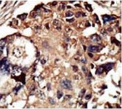 IHC testing of FFPE human breast cancer tissue with PACSIN1 antibody. HIER: steam section in pH6 citrate buffer for 20 min and allow to cool prior to staining.