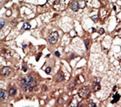 IHC testing of FFPE human cancer tissue with EPS8 antibody. HIER: steam section in pH6 citrate buffer for 20 min and allow to cool prior to staining.