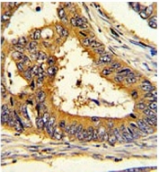 IHC testing of FFPE human colon carcinoma tissue with SCAP antibody. HIER: steam section in pH6 citrate buffer for 20 min and allow to cool prior to staining.