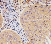 IHC testing of FFPE human cervical carcinoma tissue with GCLM antibody. HIER: steam section in pH6 citrate buffer for 20 min and allow to cool prior to staining.
