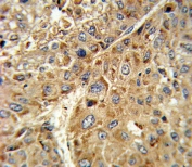 IHC testing of FFPE human hepatocarcinoma tissue with GPX1 antibody. HIER: steam section in pH6 citrate buffer for 20 min and allow to cool prior to staining.