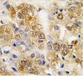 IHC testing of FFPE human prostate carcinoma with HSPA5 antibody. HIER: steam section in pH6 citrate buffer for 20 min and allow to cool prior to staining.