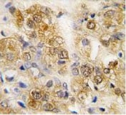 IHC testing of FFPE human prostate carcinoma with HSPA5 antibody. HIER: steam section in pH6 citrate buffer for 20 min and allow to cool prior to staining.