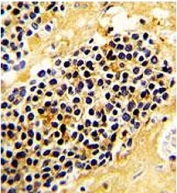 IHC testing of FFPE human kidney carcinoma with NKG2A antibody. HIER: steam section in pH6 citrate buffer for 20 min and allow to cool prior to staining.