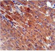 IHC testing of FFPE human hepatocarcinoma with Carboxylesterase 2 antibody. HIER: steam section in pH6 citrate buffer for 20 min and allow to cool prior to staining.