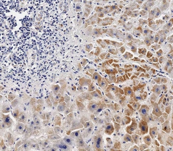 IHC testing of FFPE human hepatocarinoma with BCKDHB antibody. HIER: steam section in pH6 citrate buffer for 20 min and allow to cool prior to staining.