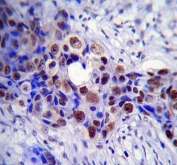 IHC testing of FFPE human breast carcinoma tissue with HDAC2 antibody. HIER: steam section in pH6 citrate buffer for 20 min and allow to cool prior to staining.