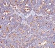 IHC testing of FFPE human colon carcinoma tissue with IFITM3 antibody. HIER: steam section in pH6 citrate buffer for 20 min and allow to cool prior to staining.