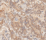 IHC testing of FFPE human thyroid carcinoma tissue with DLL3 antibody. HIER: steam section in pH6 citrate buffer for 20 min and allow to cool prior to staining.