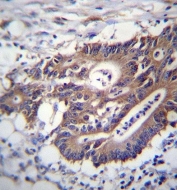 IHC testing of FFPE human colon carcinoma tissue with Cytokeratin 12 antibody. HIER: steam section in pH6 citrate buffer for 20 min and allow to cool prior to staining.