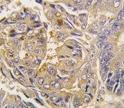 IHC testing of FFPE human colon carcinoma tissue with ATG16L antibody. HIER: steam section in pH6 citrate buffer for 20 min and allow to cool prior to staining.
