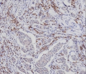 IHC testing of FFPE human breast carcinoma tissue with phospho-CDC25A antibody. HIER: steam section in pH9 EDTA for 20 min and allow to cool prior to staining.