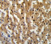 IHC testing of FFPE human hepatocarcinoma tissue with ADH5 antibody. HIER: steam section in pH6 citrate buffer for 20 min and allow to cool prior to staining.