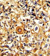 IHC testing of FFPE human breast carcinoma tissue with PTAR1 antibody. HIER: steam section in pH6 citrate buffer for 20 min and allow to cool prior to staining.