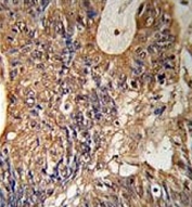 IHC testing of FFPE human colon carcinoma tissue with GST pi antibody. HIER: steam section in pH6 citrate buffer for 20 min and allow to cool prior to staining.