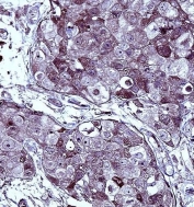 IHC testing of FFPE human breast carcinoma tissue with IRF7 antibody. HIER: steam section in pH6 citrate buffer for 20 min and allow to cool prior to staining.