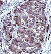 IHC testing of FFPE human colon carcinoma tissue with IRF7 antibody. HIER: steam section in pH6 citrate buffer for 20 min and allow to cool prior to staining.