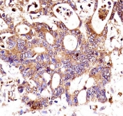 IHC testing of FFPE human colon carcinoma tissue with  Catenin Beta antibody. HIER: steam section in pH6 citrate buffer for 20 min and allow to cool prior to staining.