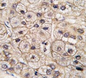 IHC testing of FFPE human hepatocellular carcinoma tissue with CD133 antibody. HIER: steam section in pH6 citrate buffer for 20 min and allow to cool prior to staining.