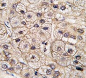 IHC testing of FFPE human hepatocellular carcinoma tissue with CD133 antibody. HIER: steam section in pH6 citrate buffer for 20 min and allow to cool prior to staining.