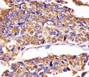 IHC testing of FFPE human lung adenocarcinoma tissue with Hsp60 antibody. HIER: steam section in pH6 citrate buffer for 20 min and allow to cool prior to staining.