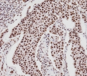 IHC testing of FFPE human breast cancer with Retinoblastoma antibody. HIER: steam section in pH9 EDTA for 20 min and allow to cool prior to staining.