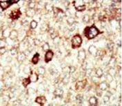 IHC testing of FFPE human cancer tissue with FGFR4 antibody. HIER: steam section in pH6 citrate buffer for 20 min and allow to cool prior to staining.