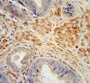 IHC testing of FFPE human prostate carcinoma tissue with Follistatin-like 1 antibody. HIER: steam section in pH6 citrate buffer for 20 min and allow to cool prior to staining.
