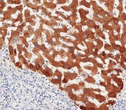 IHC testing of FFPE human hepatocarcinoma tissue with Haptoglobin antibody. HIER: steam section in pH9 EDTA for 20 min and allow to cool prior to staining.