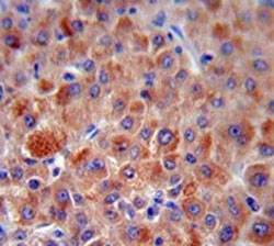 IHC testing of FFPE human hepatocellular carcinoma tissue with Complement factor H antibody. HIER: steam section in pH6 citrate buffer for 20 min and allow to cool prior to staining.
