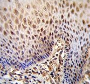 IHC testing of FFPE human esophageal carcinoma tissue with WDR70 antibody. HIER: steam section in pH6 citrate buffer for 20 min and allow to cool prior to staining.