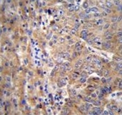 IHC testing of FFPE human hepatocarcinoma with DIEXF antibody. HIER: steam section in pH6 citrate buffer for 20 min and allow to cool prior to staining.